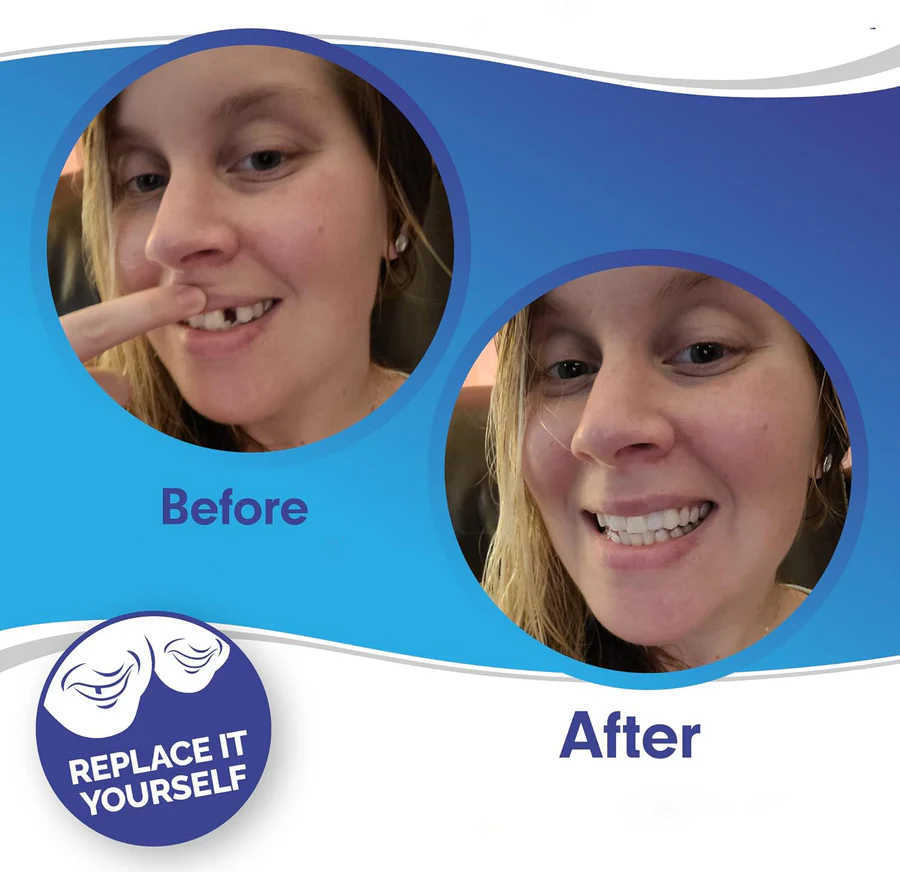 Full Dental Veneer Kit – Upper & Lower Cosmetic Covers