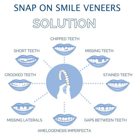 Full Dental Veneer Kit – Upper & Lower Cosmetic Covers