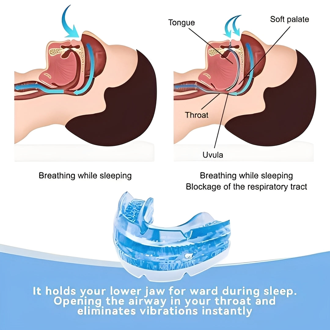 Adjustable Mouldable Mouthpiece with Screw-Based Fit for Nighttime Use