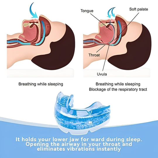 Adjustable Mouldable Mouthpiece with Screw-Based Fit for Nighttime Use