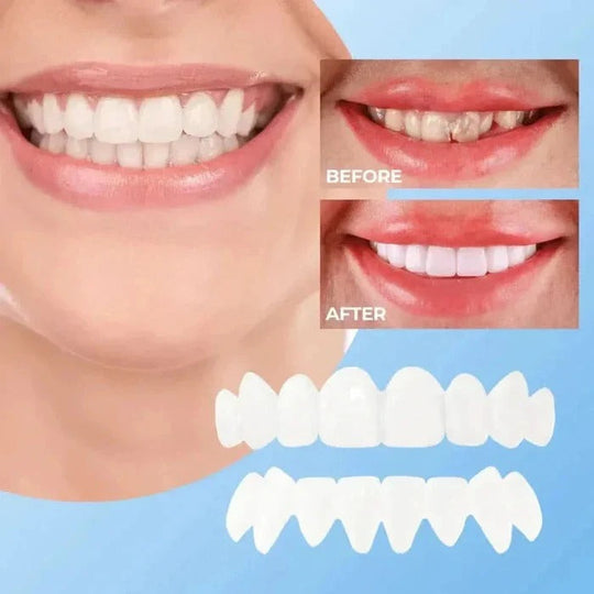 Clip-On Cosmetic Veneers and Temporary Tooth Covers