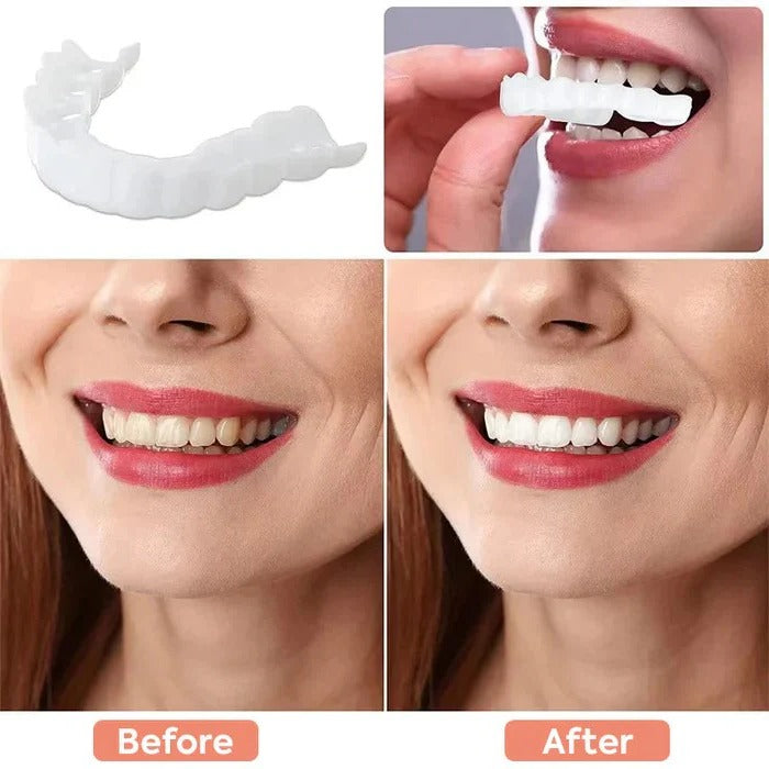 Clip-On Cosmetic Veneers and Temporary Tooth Covers