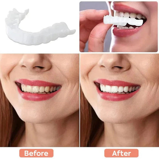 Clip-On Cosmetic Veneers and Temporary Tooth Covers