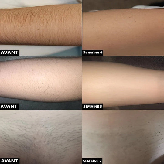 Rechargeable Light Pulse Hair Removal Device