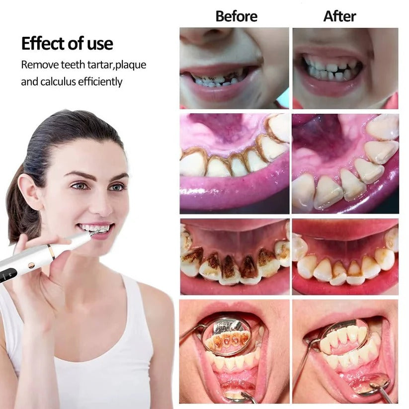USB Rechargeable Dental Cleaning Kit with LED Light